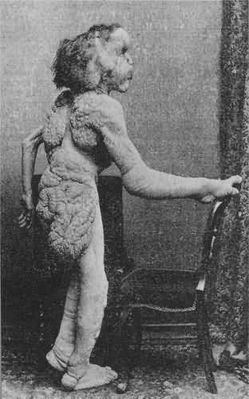 Joseph Merrick 